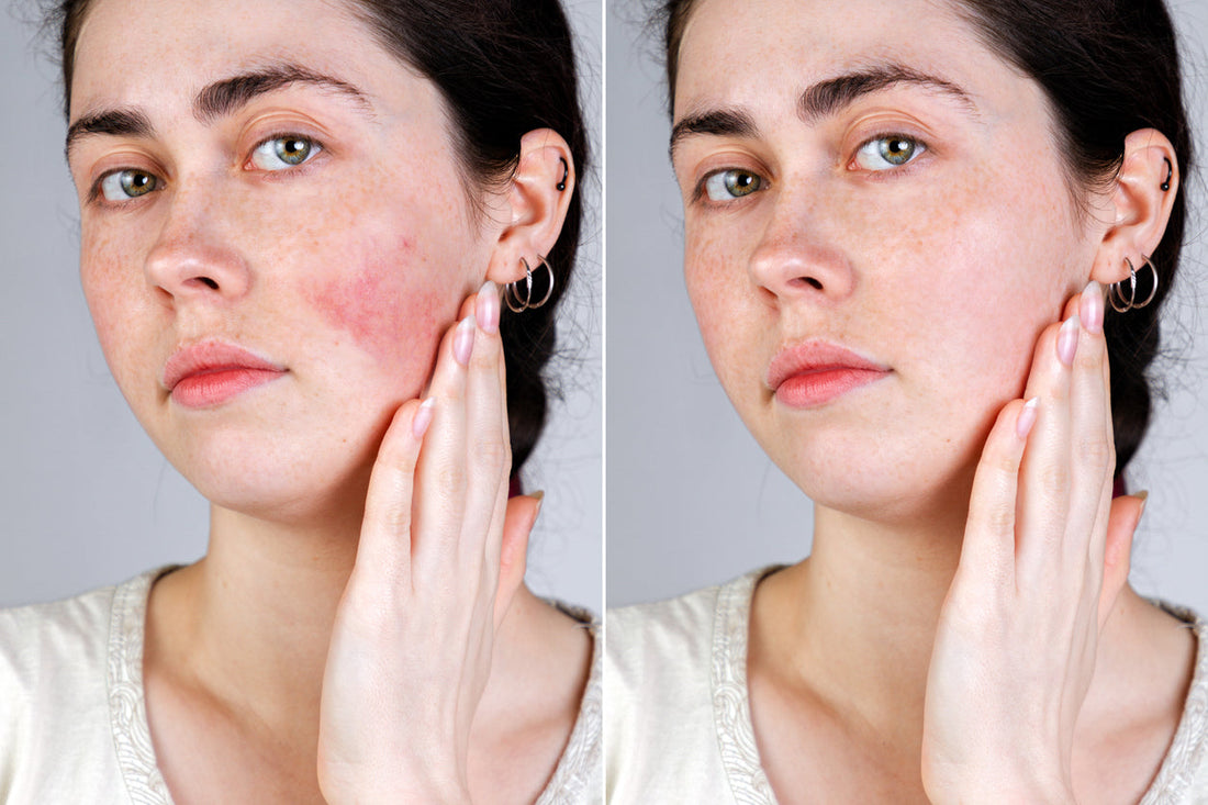 6 Tips for Rosacea Relief